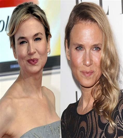 Worst Cases Of Celebrity Plastic Surgery Gone Wrong E
