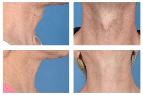 UCLA Surgeons Develop New Technique To Reduce Adams Apple Without Neck Scar UCLA