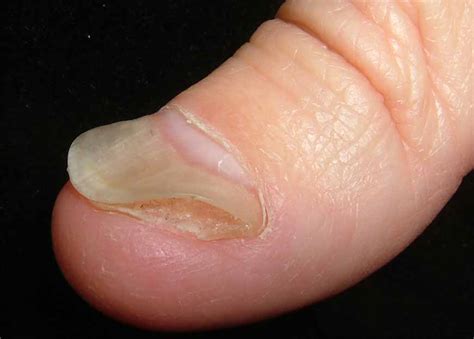Virtual Grand Rounds In Dermatology 20 Nail Dystrophy