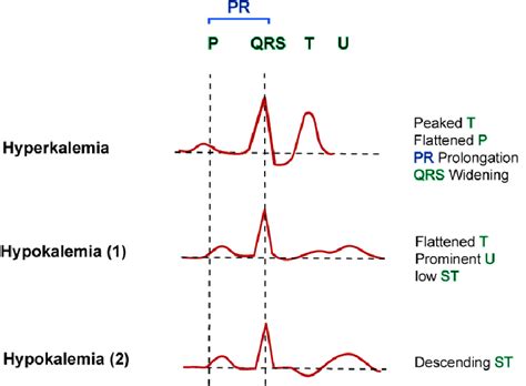 Ecg Changes In Hyperkalemia And Hypokalemia Causes Diagnosis