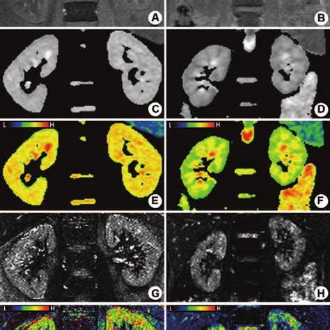 Bold And Dw Mri Of Kidneys Representative Magnetic Resonance Images