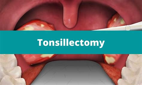 Tonsillectomy Medical Junction