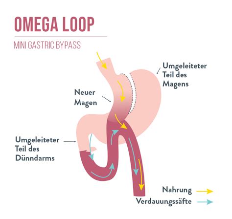 Omega Loop Mini Gastric Bypass Bariatric Advantage Europe