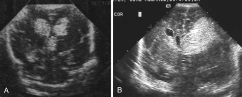 Intraventricular Hemorrhage And White Matter Injury In The Preterm