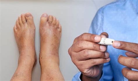 Diabetes Signs In Your Feet The 14 Symptoms To Watch Out For