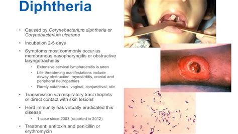 diphtheria what to know