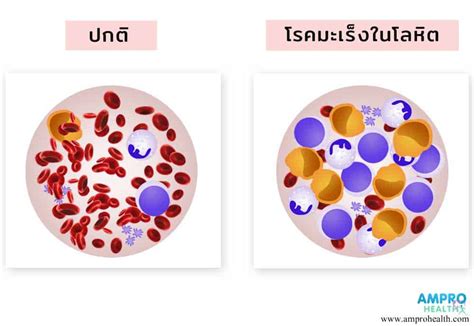 โรคมะเร็งเม็ดเลือดขาว Leukemia Am Pro Health