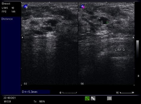 Fibrocystic Disease Of Breast Radrounds Radiology Network