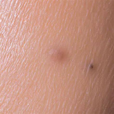 Blackheads On The Inner Thighs How To Get Rid Of Them