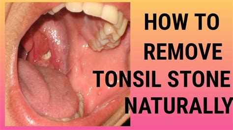 Tonsil Stone Remedy Forever How To Remove Tonsil Stone Naturally