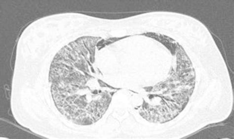 Chest Computed Tomography Ct Image Showing Pneumomediastinum And