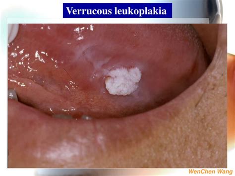 Ppt 1 White Lesions Of The Oral Mucosa 2 Solitary Oral Ulcer And