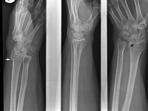 Wrist Fracture Radiography Plain Radiology