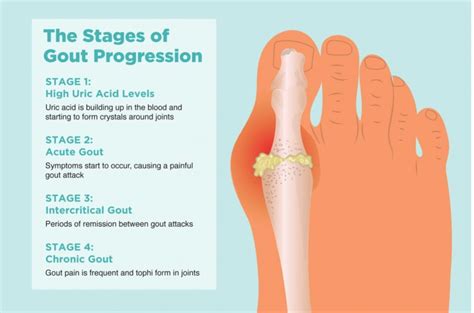 Overview Of Gout Sports Medicine Review