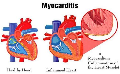 If myocarditis is causing heart failure or arrhythmias, your doctor might hospitalize you and prescribe drugs or allan ck, et al. Myocarditis Disease with Causes, Symptom and Nursing ...