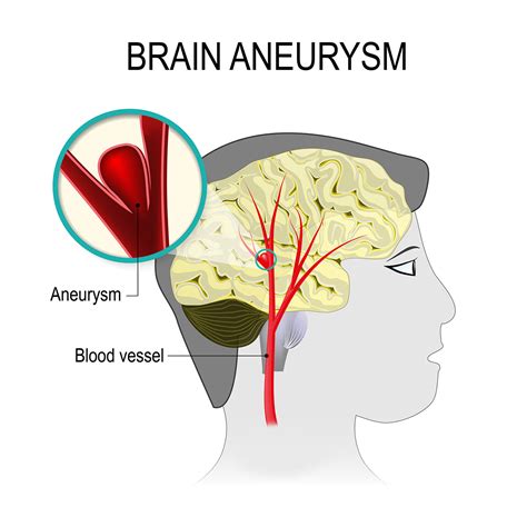 Brain Aneurysm Vejthani Hospital Jci Accredited International