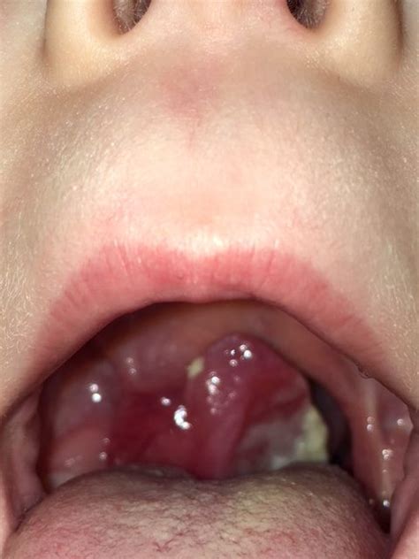 Burkitts Lymphoma Midwest Sinus And Allergy