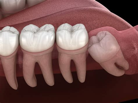 Early Stage Wisdom Tooth Infection A Comprehensive Guide