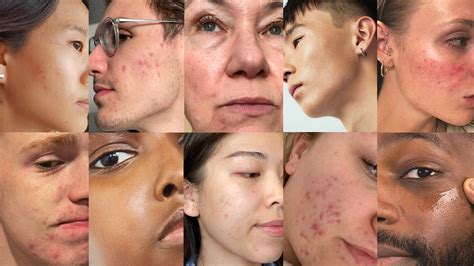 Your Guide To The Most Common Skin Concerns NØie NØie