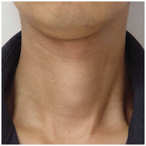 Swollen Thyroid Gland In Neck Pictures To Pin On Pinterest Pinsdaddy
