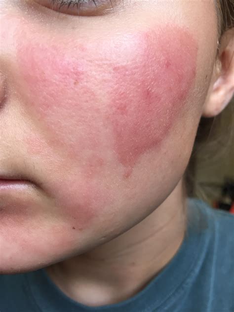 Burning Bumpy Rash Or Maybe Burn Picture Over The Counter Acne