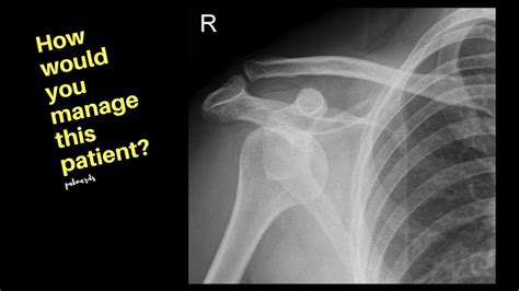 The usual mechanism of injury is indirect and consists of a combination of abduction, extension, and external rotation.10, 11 only rarely is the mechanism a direct blow to the. Anterior Shoulder Dislocation - YouTube