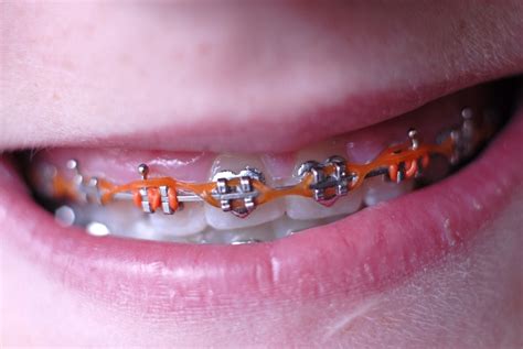 So, you have new braces. Everything You Need to Know About Elastics for Braces ...