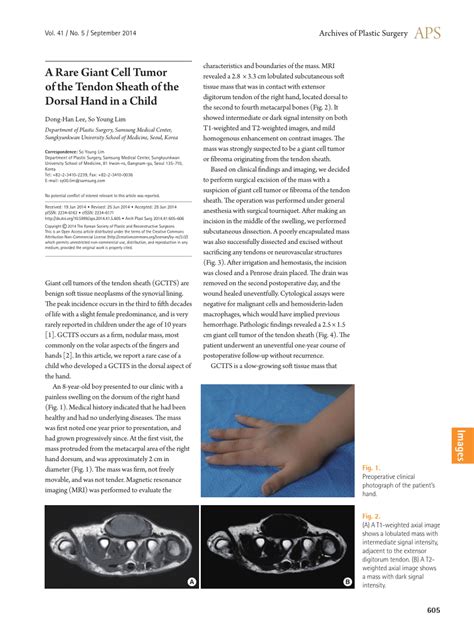 Pdf A Rare Giant Cell Tumor Of The Tendon Sheath Of The Dorsal Hand