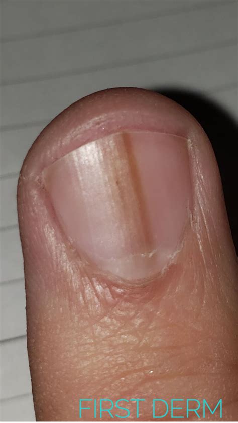 Update More Than 126 Yellow Discoloration Of Nails Super Hot