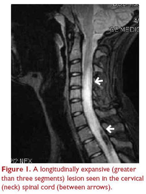 Transverse myelitis (tm) is an inflammatory disorder of the spinal cord that may be idiopathic or related to other diseases.1,2 it is characterized by acute or subacute dysfunction of the spinal cord. Transverse myelitis. Causes, symptoms, treatment ...