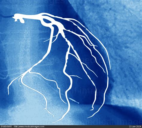 Stock Image Coronary Angiogram Coronarography Left Anterior Oblique