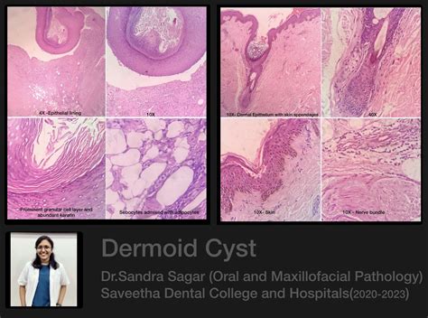 Dermoid Cyst — Oral Pathology Saveetha