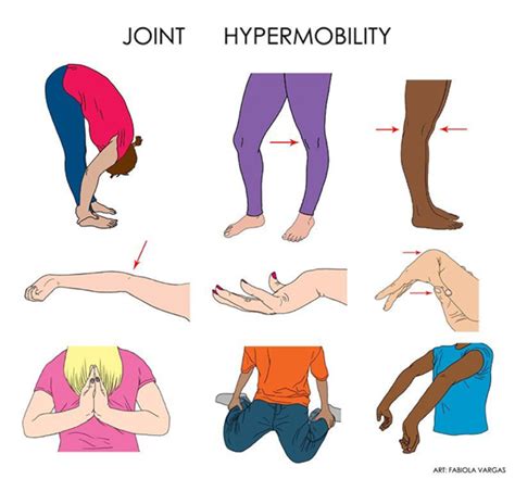 Hypermobile Ehlers Danlos Syndrome Healthwatch Central Bedfordshire