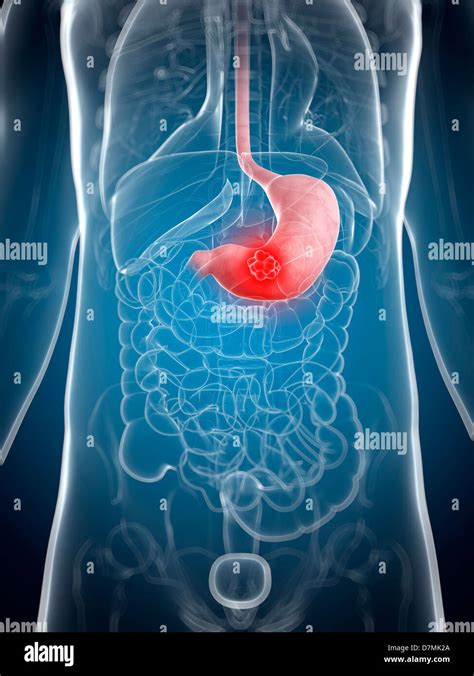Stomach Cancer Artwork Stock Photo Alamy