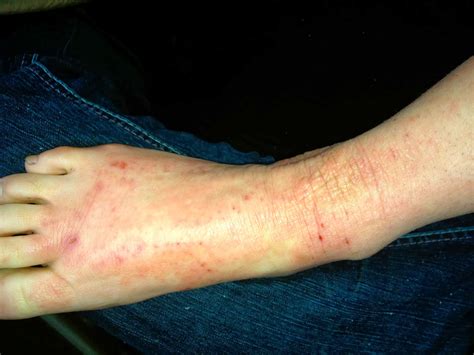 Scratching The Surface Of Topical Steroid Withdrawal Day 128