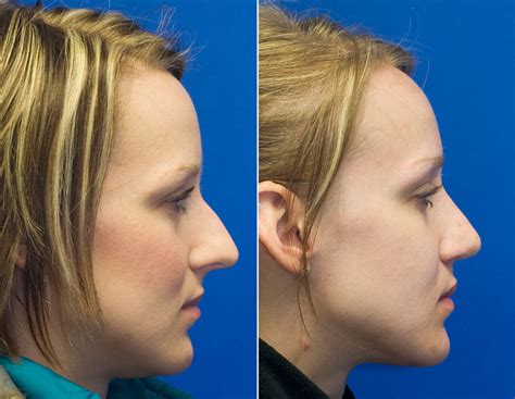 Long Over Projected Nose Rhinoplasty In Seattle