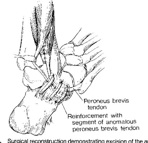 Figure 3 From Chronic Peroneal Tendon Subluxation Produced By An