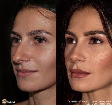 Closed Rhinoplasty Before And After Rhinoplasty Year After Surgery Dr Edgar Kaminskyi