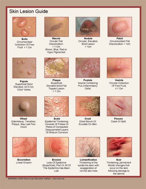 Abbas Husain On Twitter Describing A Rash Use This Reference Guide