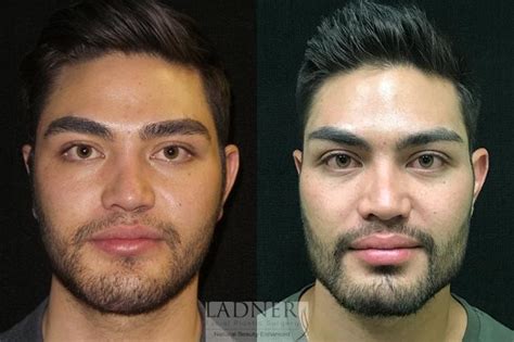 Facial Plastic Surgery For Men Before And After Photo Gallery Denver Co Ladner Facial