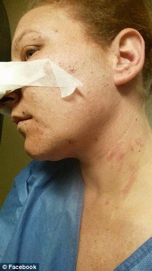 Myrtle Beach Man Bites Off Ex Girlfriend Michele Messers Nose In