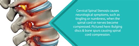 Cervical Spinal Stenosis Causes Neurological Issues Nj Spine And Orthopedic