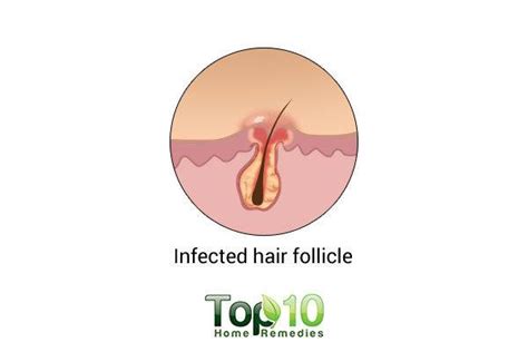 Home Remedies For Folliculitis Top 10 Home Remedies