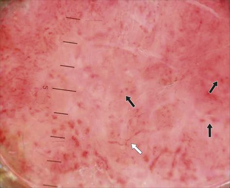 Dermoscopic Vascular Patterns In Nodular “pure” Amelanotic Melanoma