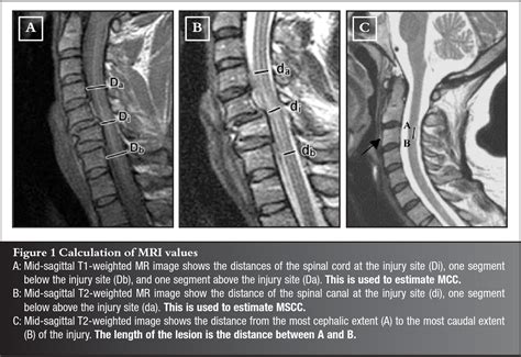 Figure From Acute Traumatic Cervical Spinal Cord Injuries Correlating Mri Findings With
