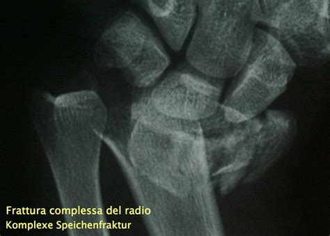 Fratture distali del radio - Dr. Frank NienstedtDr. Frank ...