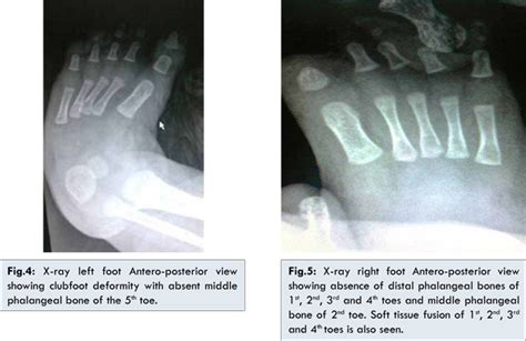 Amniotic Band Syndrome Toes