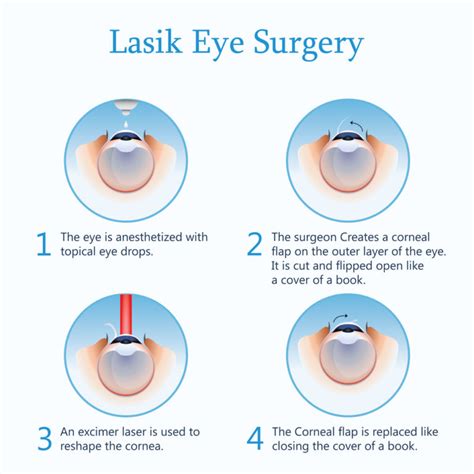 Lasik Procedure How Does Lasik Work Eye Pain Center