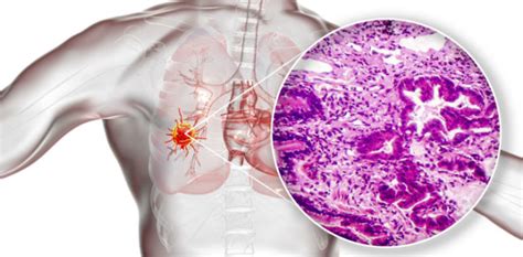 Lungenkrebs Symptome Erkennen Behandeln Herold At