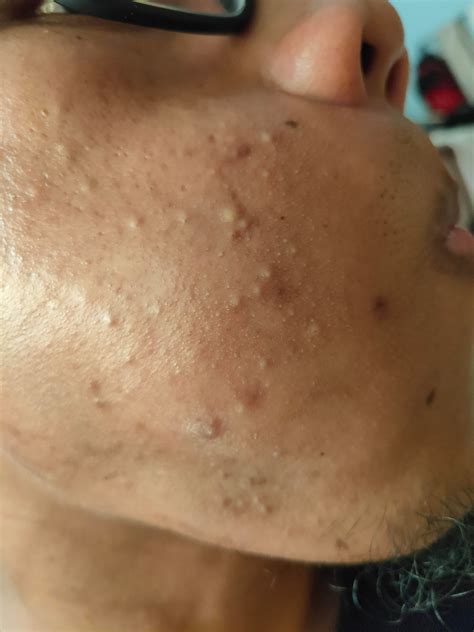 Acne Can Anyone Help Me What This Skin Problem Is And How Do I Treat
